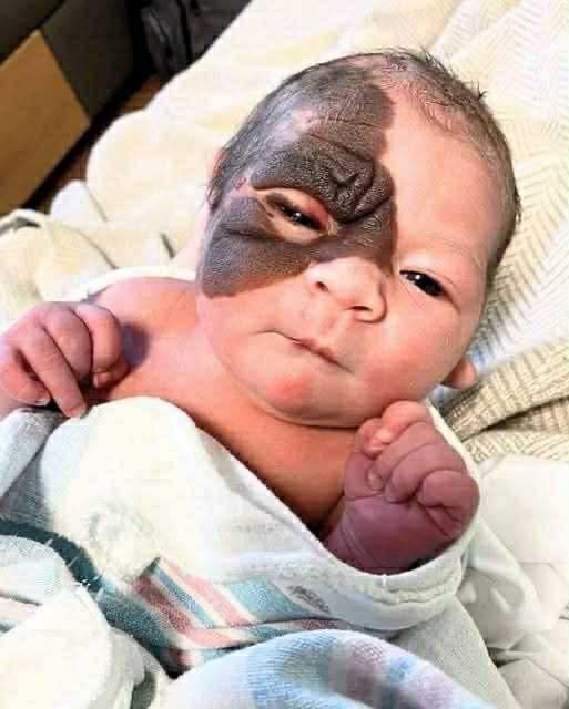 Mom on a mission to show daughter with extremely rare birthmark that she is beautiful!