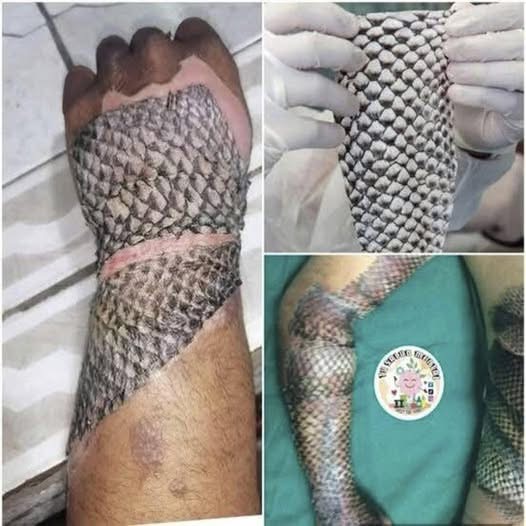 Tilapia Skin: An Innovative Alternative For Burn Recovery