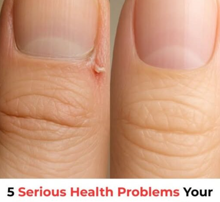 5 Serious Health Problems Your Nails Could Be Trying to Warn You About!