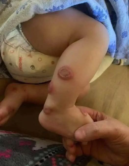 WARNING SIGNS Doctors Explain Why These Sudden Skin Patches Are Actually A Life Or Death Emergency