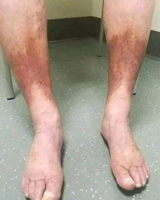 Swollen Feet! Common Causes, Warning Signs, and When to Seek Medical Advice!