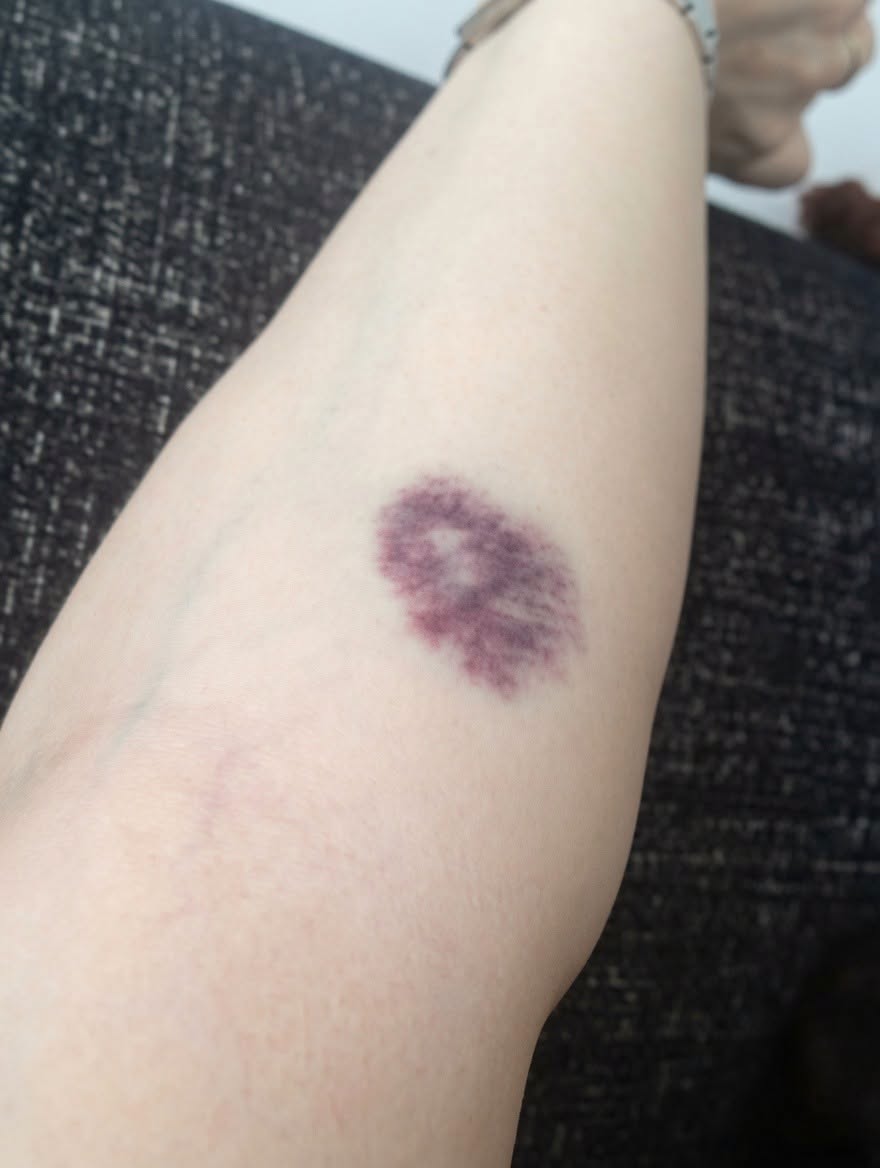 THE SILENT KILLER ON YOUR SKIN: Why Those Mysterious Bruises Are Screaming for Your Attention