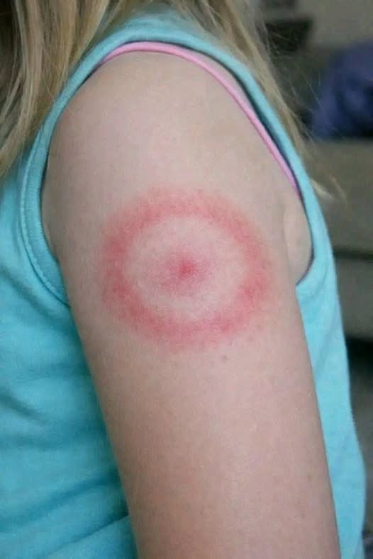 The Red Ring of Terror: Is Your Child’s Mysterious Rash a Harmless Bug Bite or a Life-Changing Diagnosis?