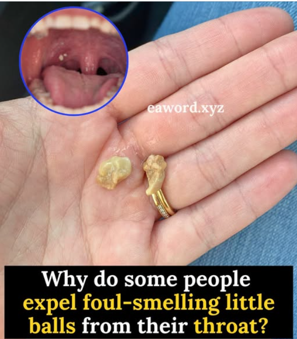 The throat stones no one expects: what they are and how to get rid of them.