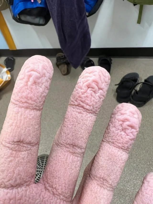 Wrinkled Fingers After Water Exposure: What Your Skin May Be Telling You