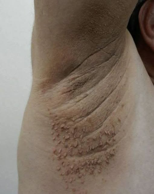 Understanding Dark Patches on the Skin: A Gentle Guide to Acanthosis Nigricans and When to Seek Care